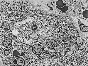 M, 23y. | acidophilic pituitary adenoma (STH)